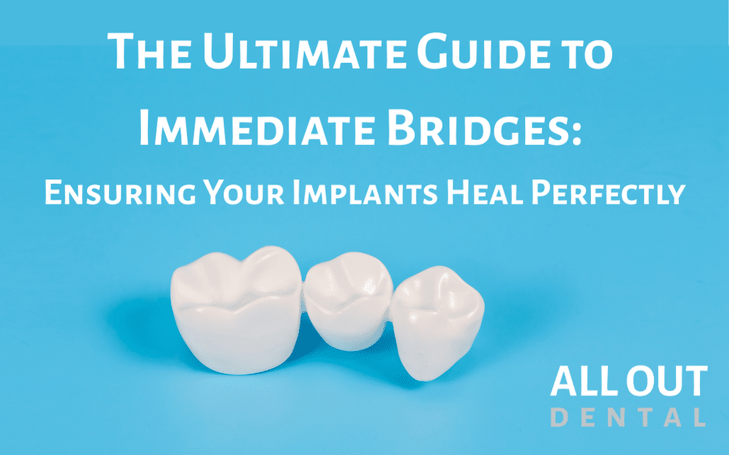 The Ultimate Guide to Immediate Bridges: Ensuring Your Implants Heal Perfectly