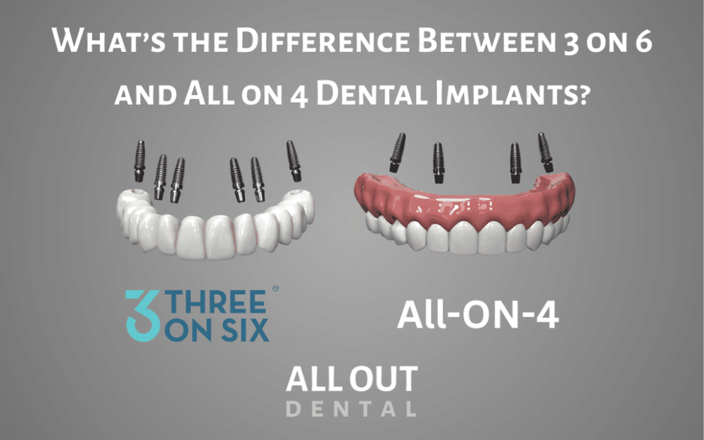 whats the difference between 3 on 6 and all on 4 dental implants?