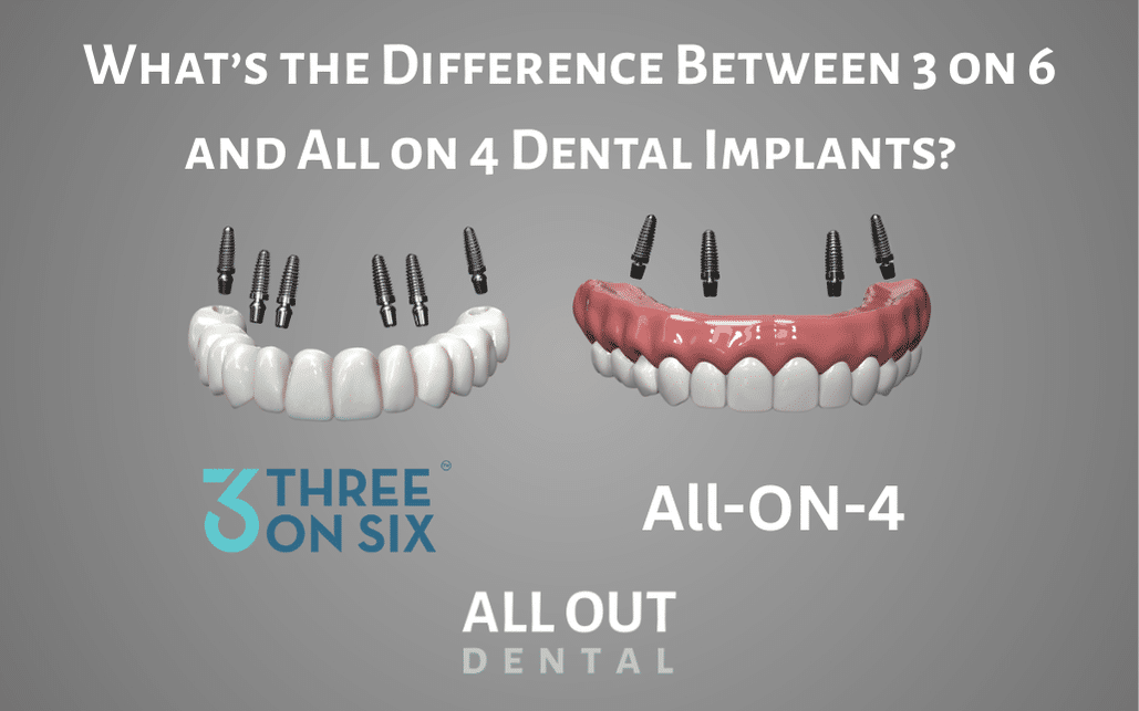 What’s the Difference Between 3 on 6 and All on 4 Dental Implants?