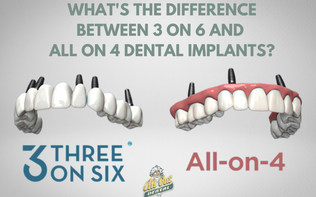 What’s the Difference Between 3 on 6 and All on 4 Dental Implants?