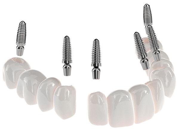 3on6 full mouth dental implants