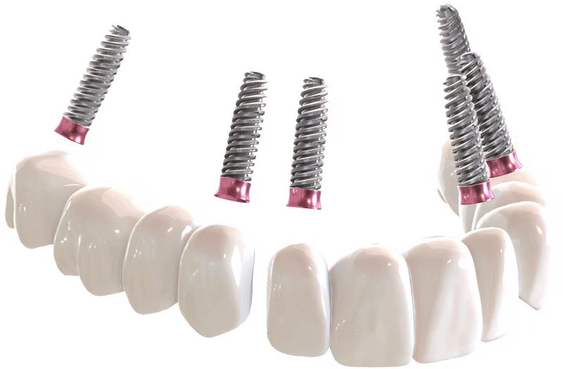 3on6_upper_TR_webI (1) 3 on 6 dental implants las vegas