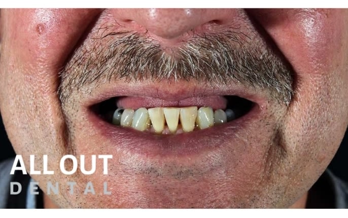 FP1 Dental Treatment