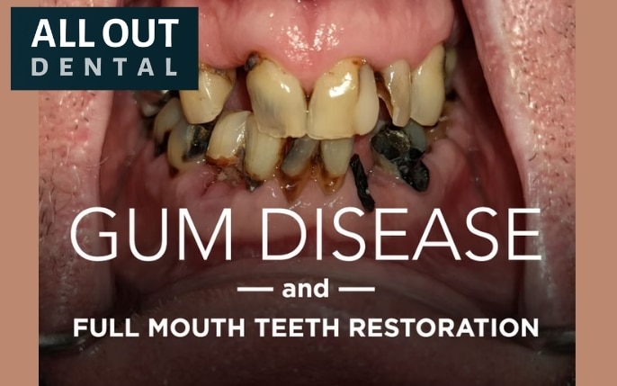 Gum Disease and Full Mouth Teeth Restoration
