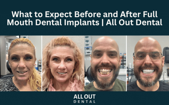 before-after-full-mouth-dental-implants-las-vegas