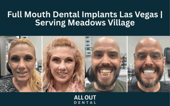 Full Mouth Dental Implants Las Vegas | Serving Meadows Village
