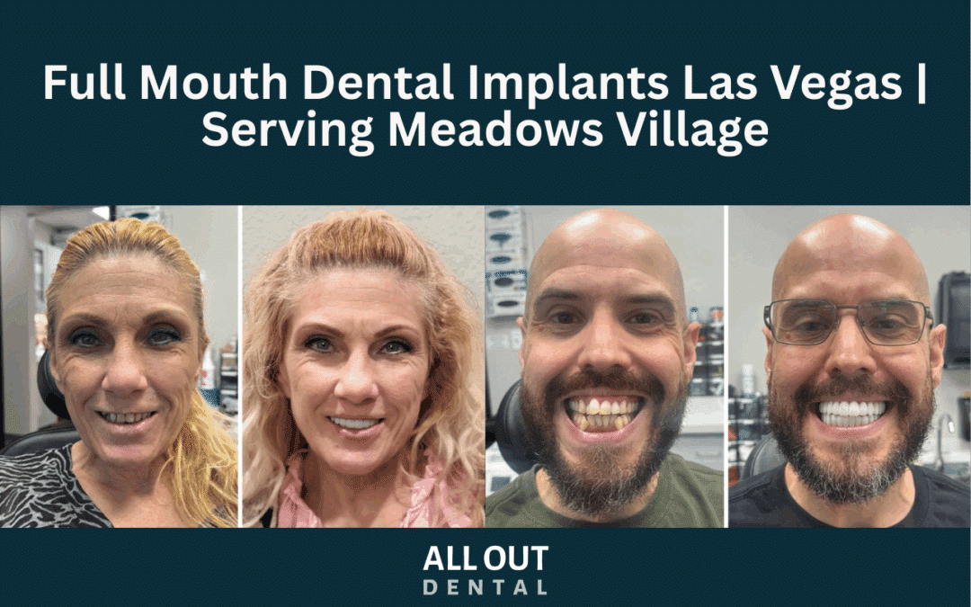 Full Mouth Dental Implants Las Vegas | Serving Meadows Village