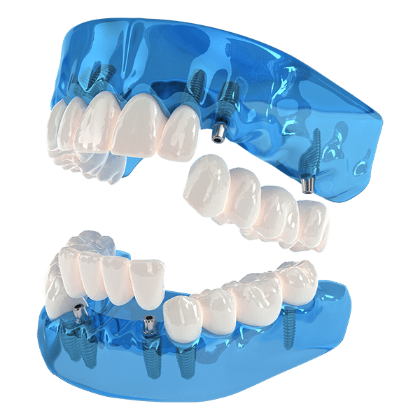 full mouth dental implants
