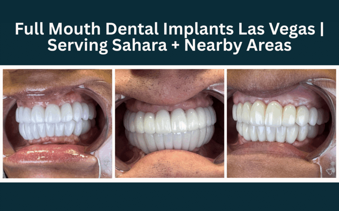 Full Mouth Dental Implants Las Vegas | Serving Sahara & Nearby Areas