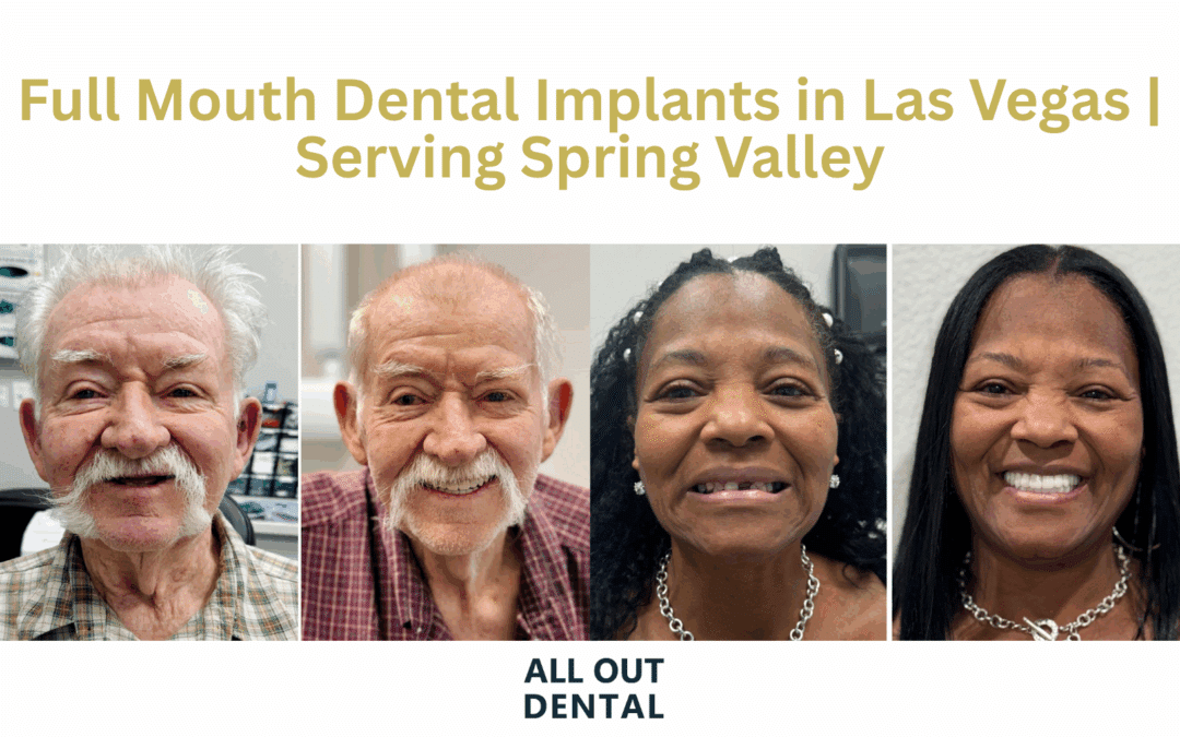 Full Mouth Dental Implants in Las Vegas | Serving Spring Valley