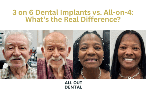 3-on-6-dental-implants-vs-all-on-4-whats-the-real-difference