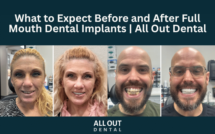 What to Expect Before and After Full Mouth Dental Implants | All Out Dental