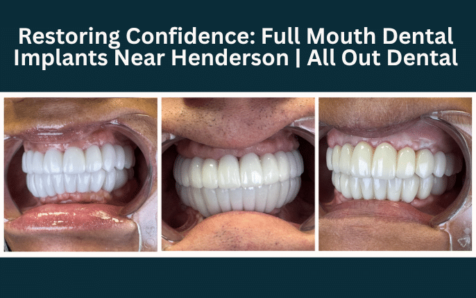 Restoring Confidence: Full Mouth Dental Implants Near Henderson | All Out Dental