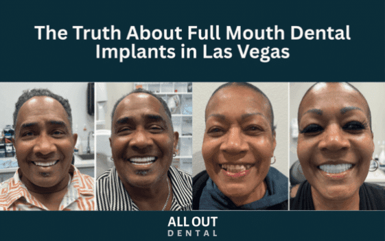full-mouth-dental-implants-las-vegas-truth-1080x675