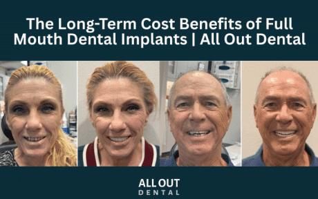 long-term-cost-benefits-of-full-mouth-dental-implants