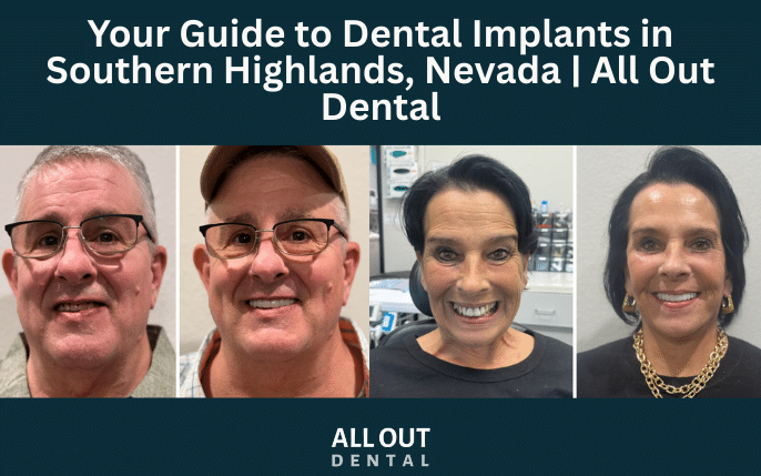 Your Guide to Dental Implants in Southern Highlands, Nevada | All Out Dental