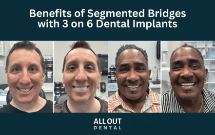 benefits-of-segmented-bridges-3-on-6-dental-implants-las-vegas.html