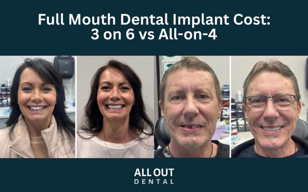 Full Mouth Dental Implant Cost: 3 on 6 vs All-on-4