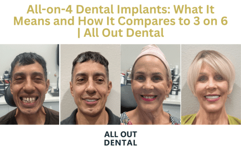 all-on-4-dental-implants-las-vegas
