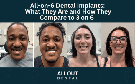 all-on-6-dental-implants-las-vegas