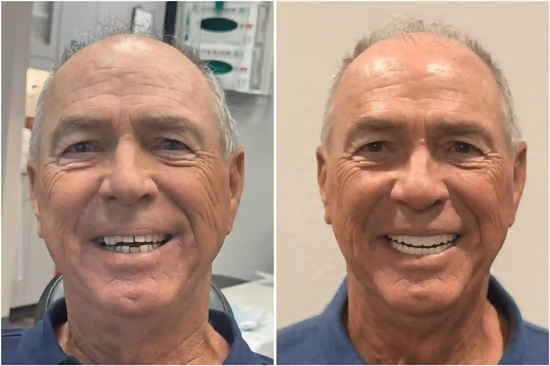 dental implants las vegas patient 4