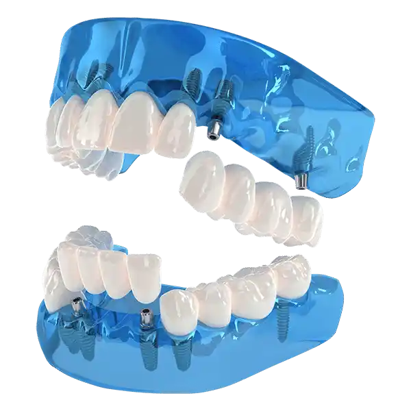 3 on 6 dental implants