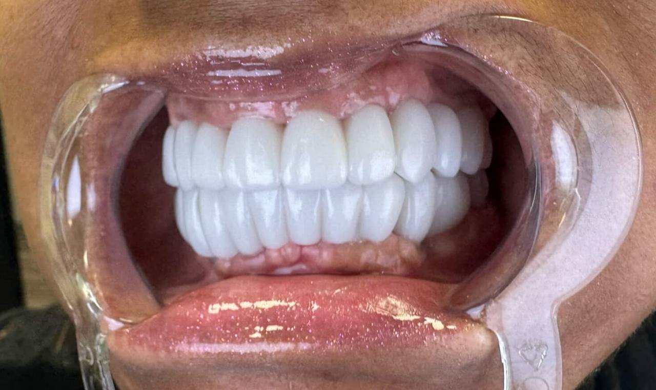 Keep Your Gums All Out Dental