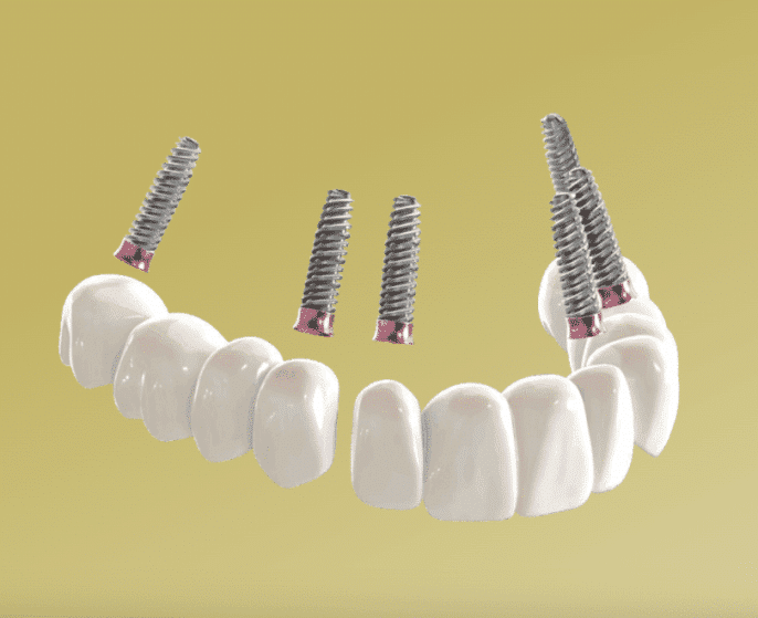 3 on 6 dental implants