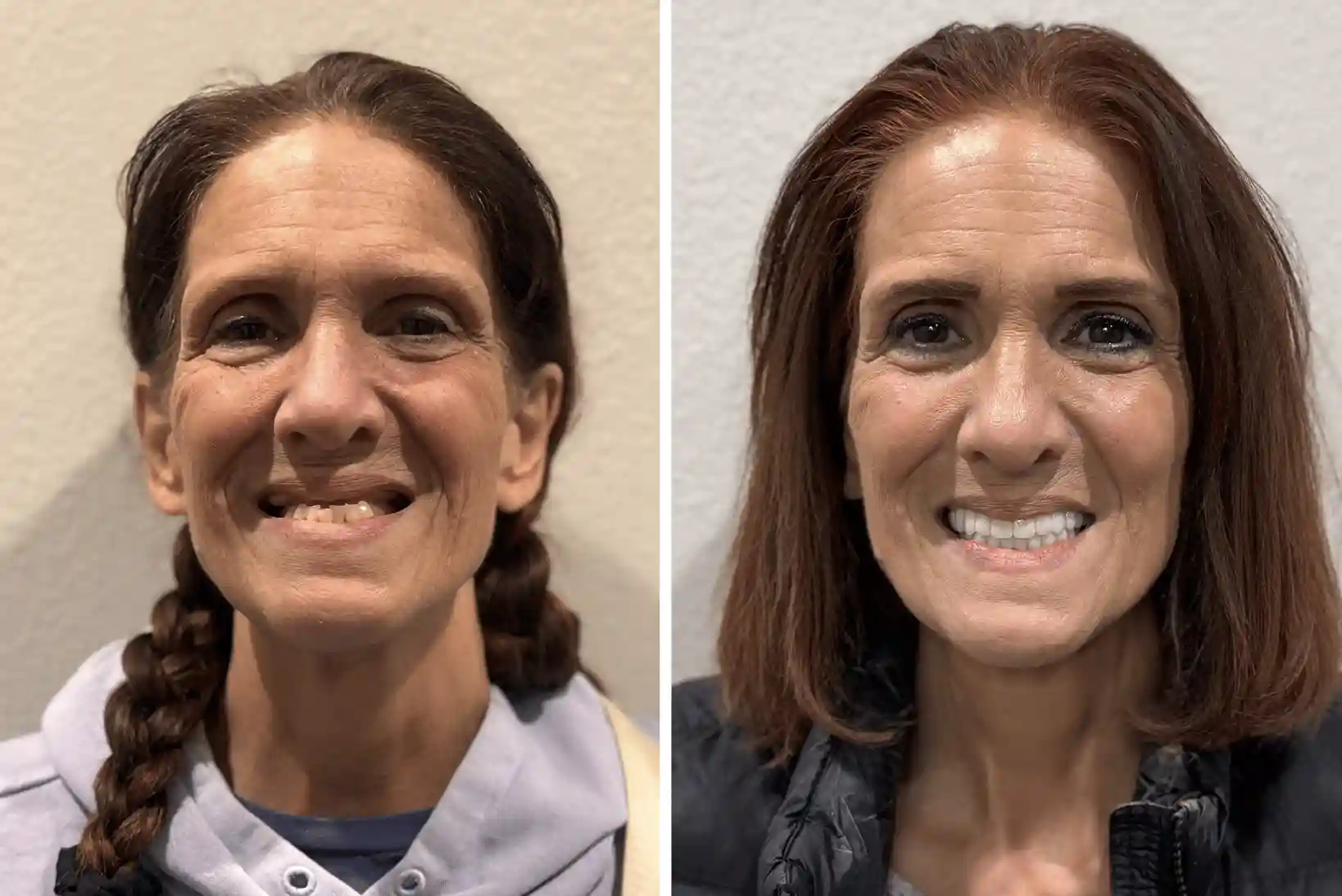 las vegas dental implant patient