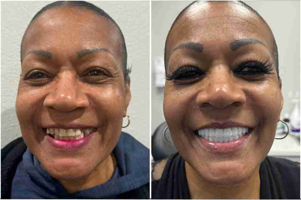 dental implants las vegas 3on6 patient