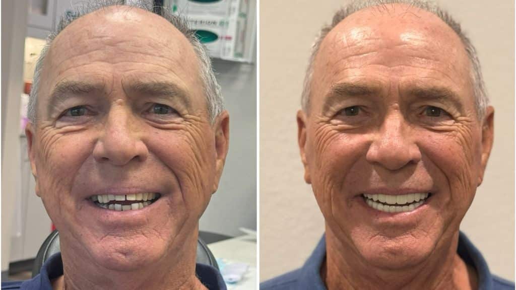 What are the benefits of 3 on 6™ dental implants?