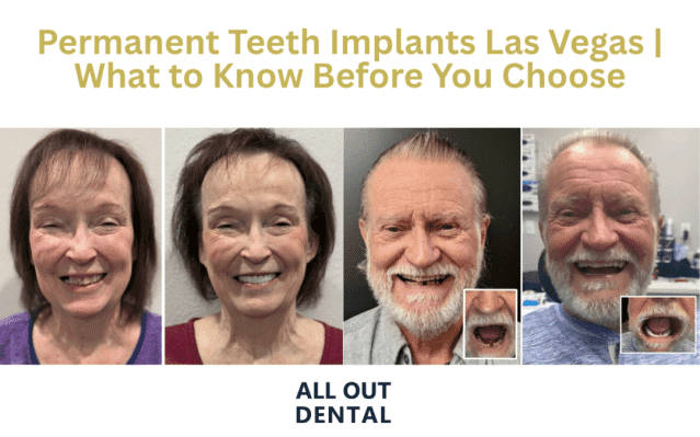 Permanent Teeth Implants Las Vegas | What to Know Before You Choose