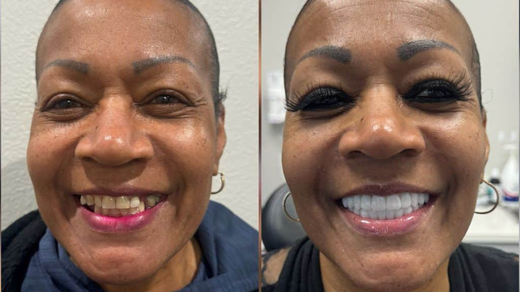 Full Mouth Dental Implants