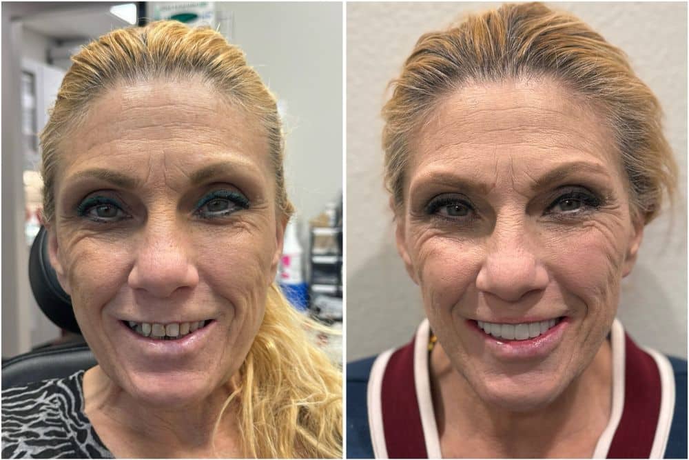 When Is Bone Grafting Needed for Dental Implants?