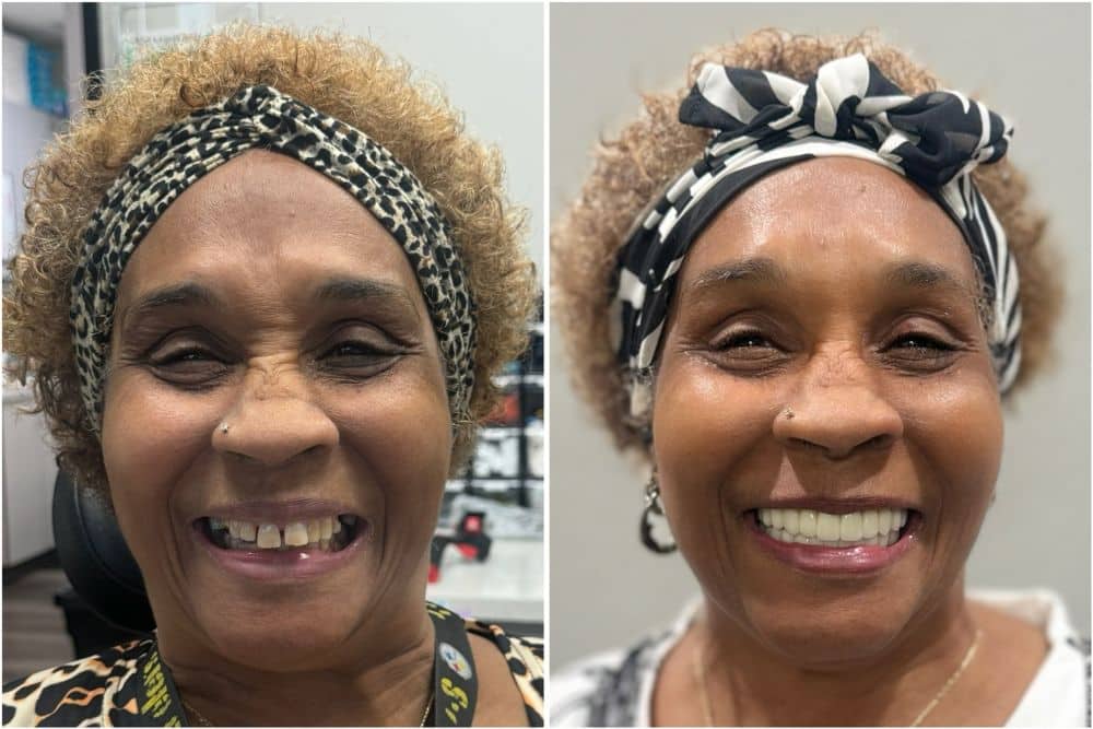 Dental Implants Feel Like Natural Teeth