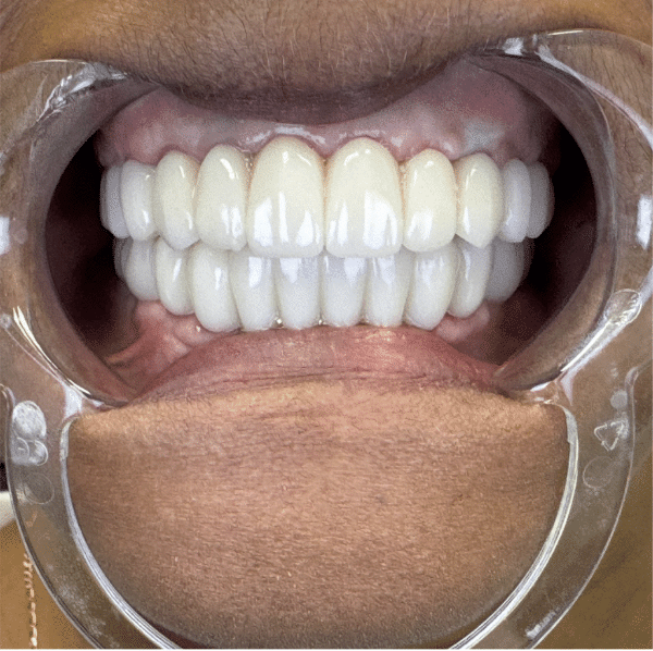 Keep your gums with 3 on 6 dental implants in Las Vegas